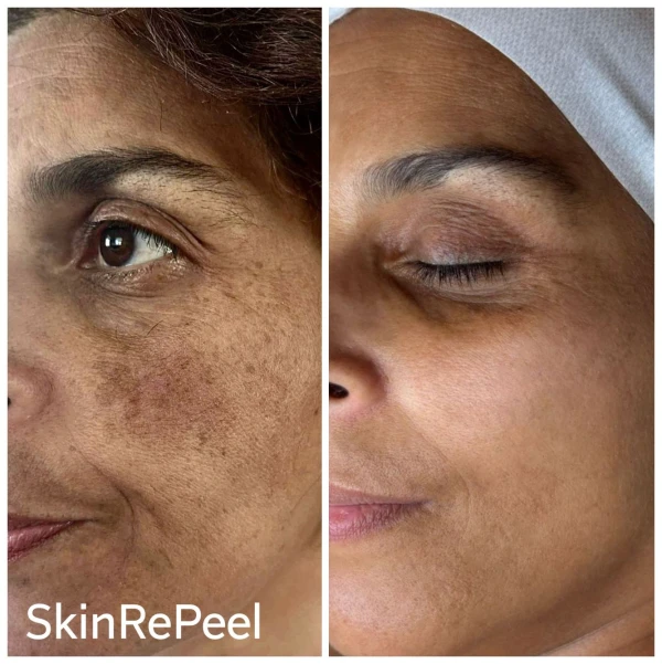 resultaat van de skinrepeel