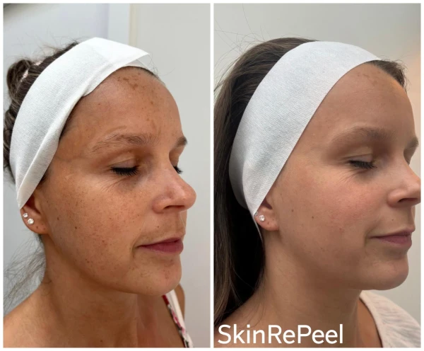 resultaat van de skinrepeel