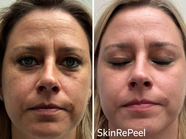 resultaat van de skinrepeel